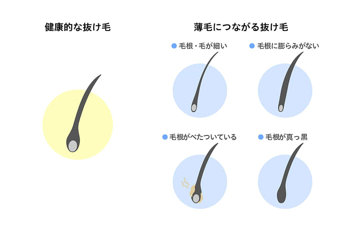 抜け毛の種類見分け方